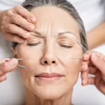 Botox Vs. Acupuncture for Wrinkles: Which Is Right for Me?