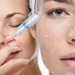 Can Microneedling Help With Acne Scars