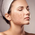 Microneedling For Body Concerns Like Cellulite