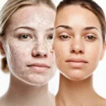 Acne Scars vs Post-Inflammatory Hyperpigmentation: Differentiating and Treating