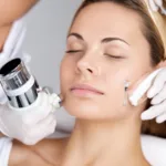 Microdermabrasion for Acne Scars